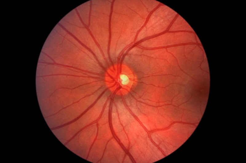 Glaucoma Webster Groves, MO